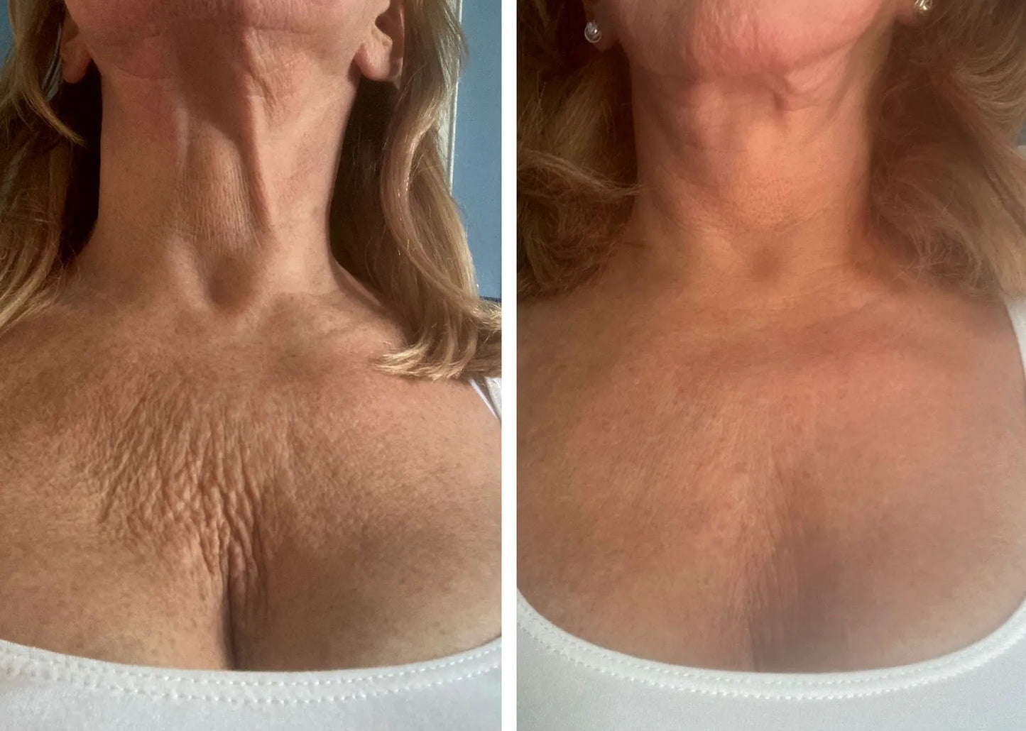 Silikonové náplasti proti vráskám – oči, čelo a dekolt (balíček)