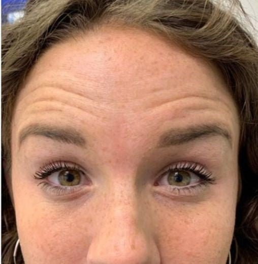 Koža pred uporabo obližev LUMINE