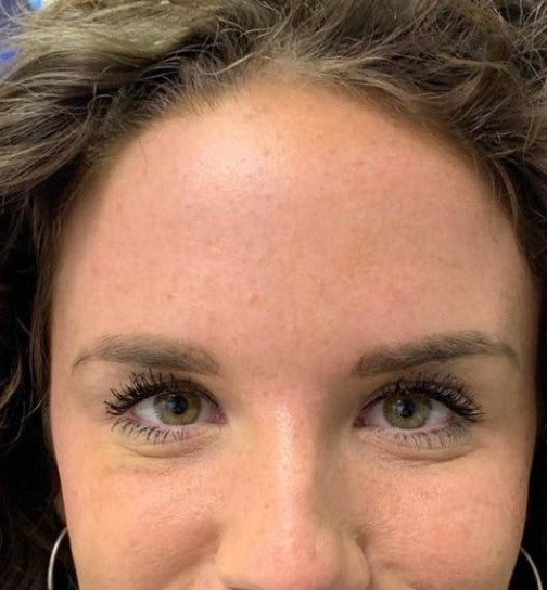 Koža po uporabi obližev LUMINE