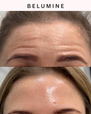 Silikonová náplast na vrásky na čele