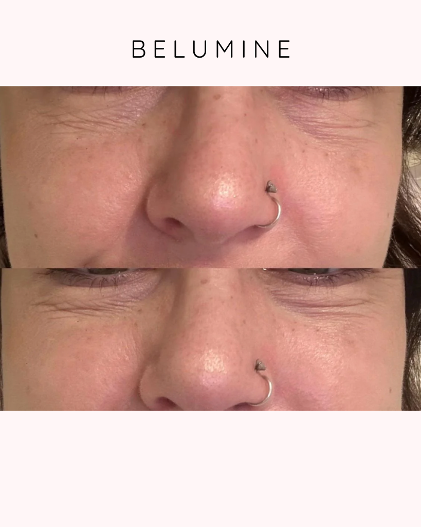 Silikonski obliž za gube okoli oči