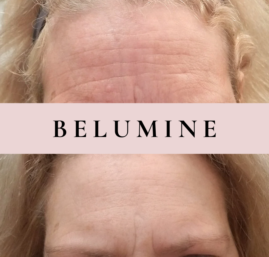 Silikonová náplast na vrásky na čele