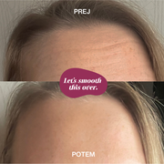 Silikonová náplast na vrásky na čele